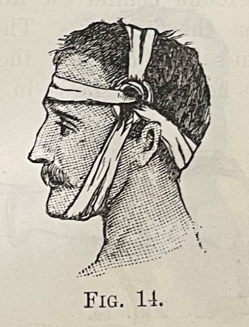 An illustrative example of the correct way to bandage a wound to the temporal artery, which runs up the side of the forehead.