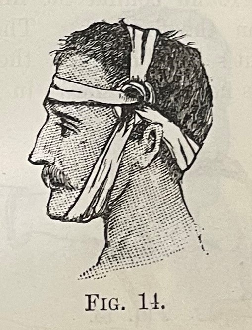 The illustration shows a side-on head and neck of a man looking to the left. The man has a moustache. He has a bandage tied around his head. The illustration has the words ‘Fig 14’ underneath.