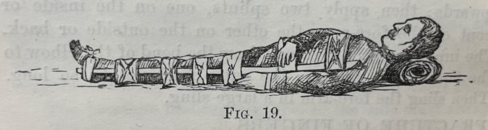 This illustration shows a man lying on the floor sideways. The man has something underneath his head to cushion it. He has a long wooden splint bandaged to his body at the leg and waist. The illustration has the words ‘Fig 19’ underneath.